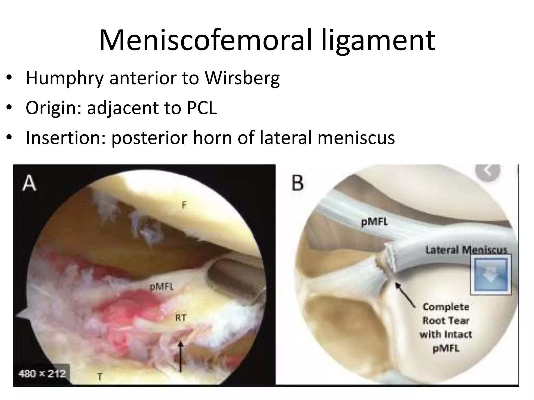 Meniscofemoral ligament
• Humphry anterior to Wirsberg
• Origin: adjacent to PCL
• Insertion: posterior horn of lateral meniscus
 