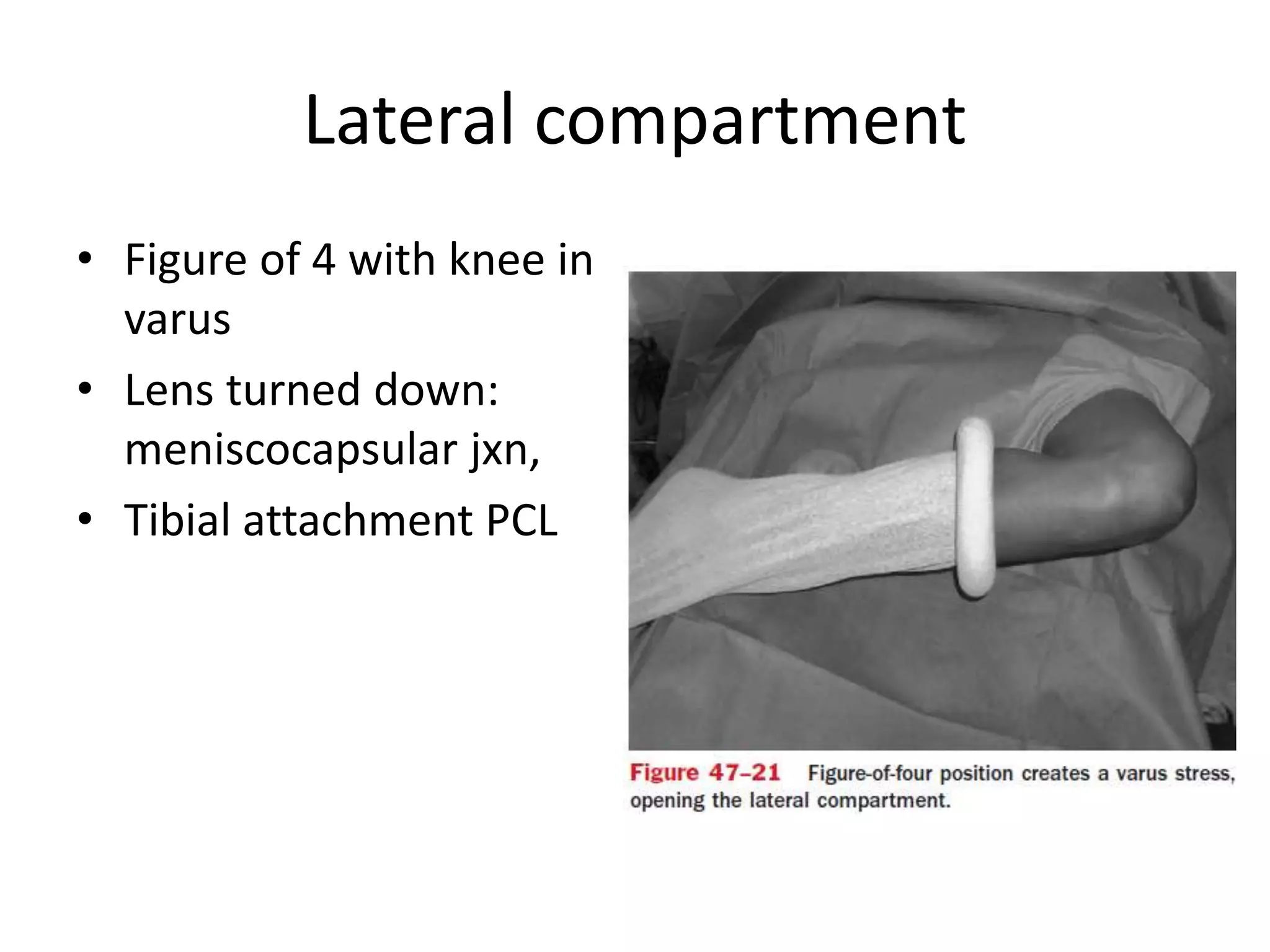 Lateral compartment
• Figure of 4 with knee in
varus
• Lens turned down:
meniscocapsular jxn,
• Tibial attachment PCL
 