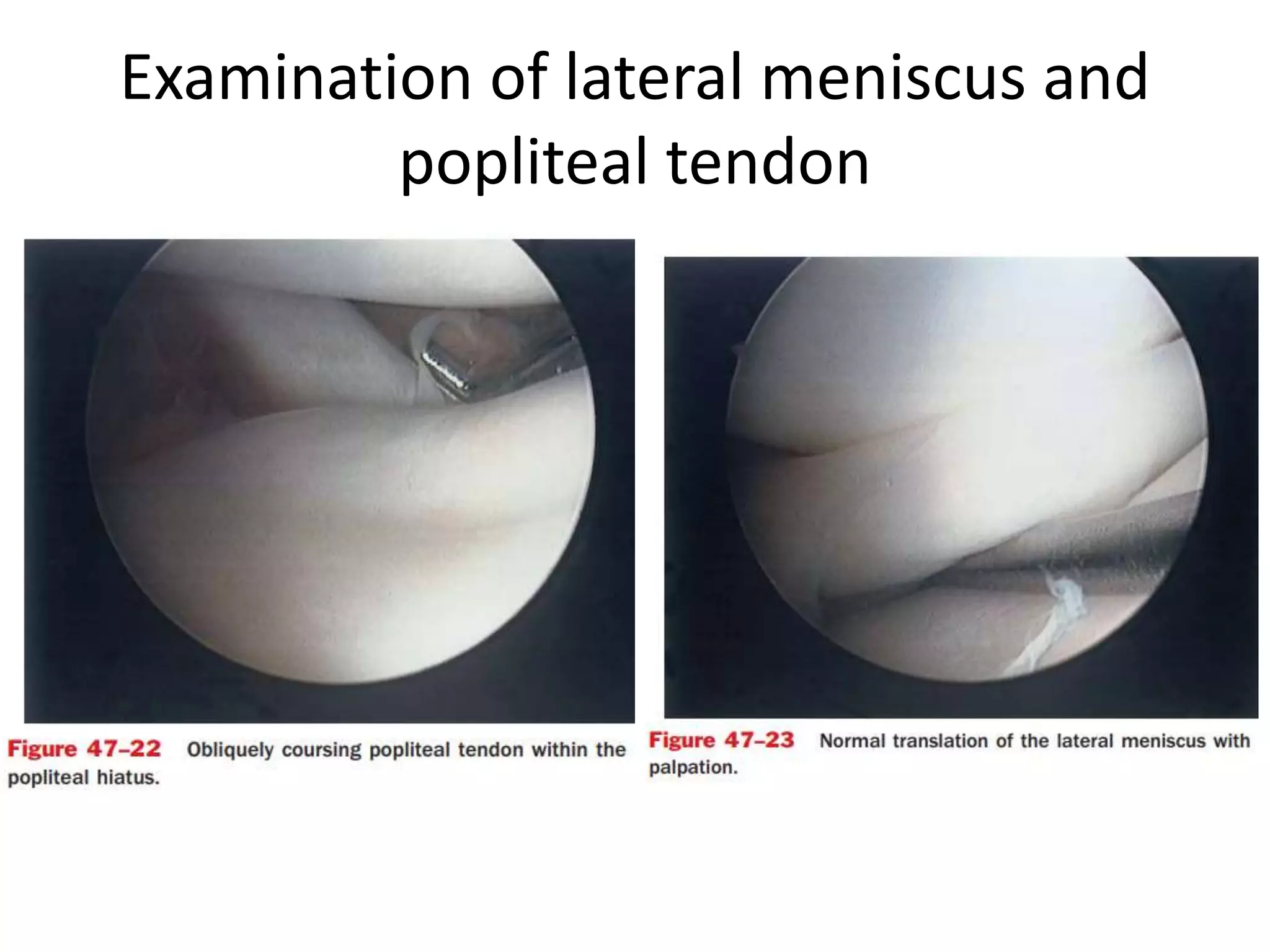 Examination of lateral meniscus and
popliteal tendon
 