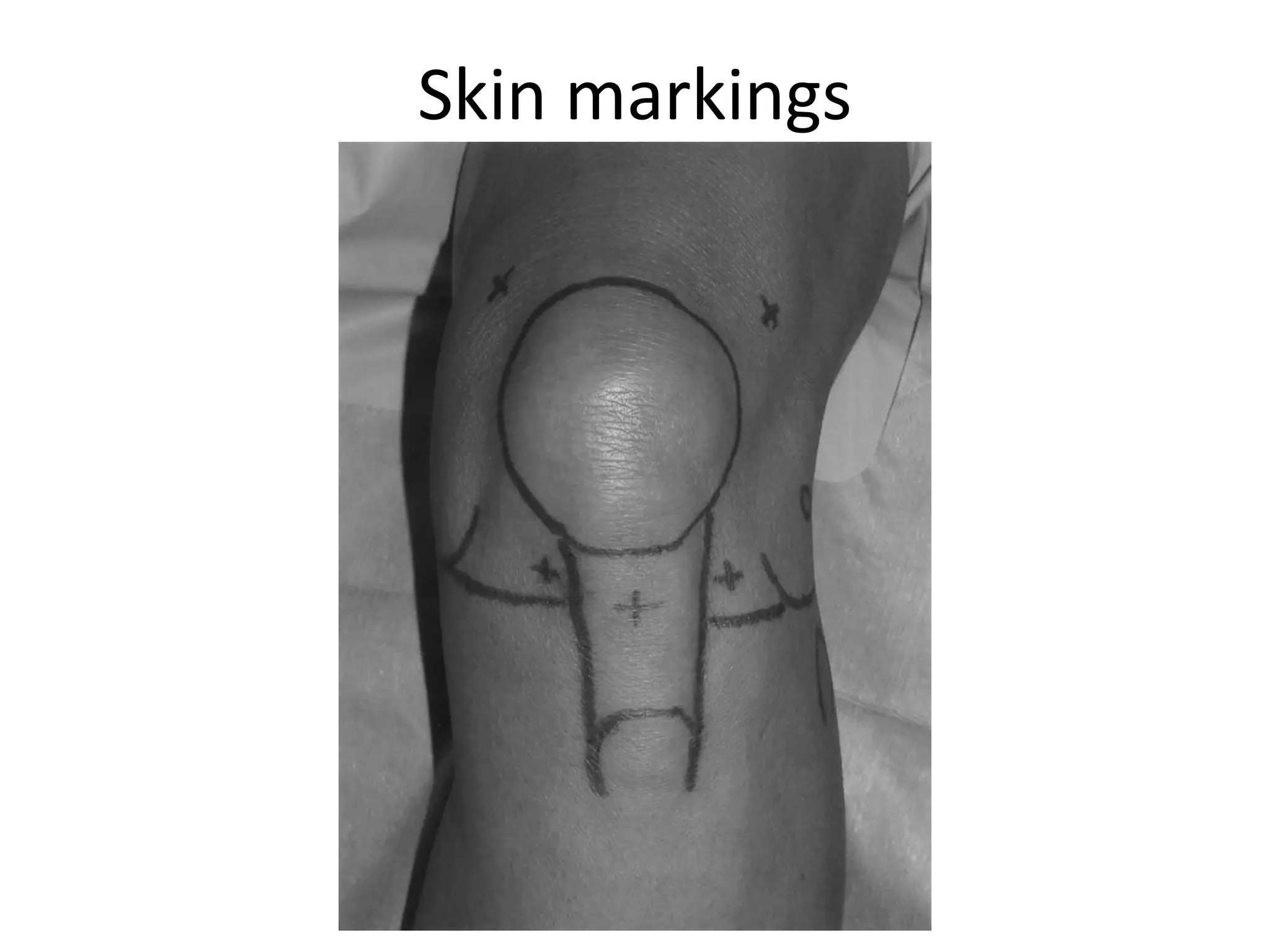 Skin markings
 