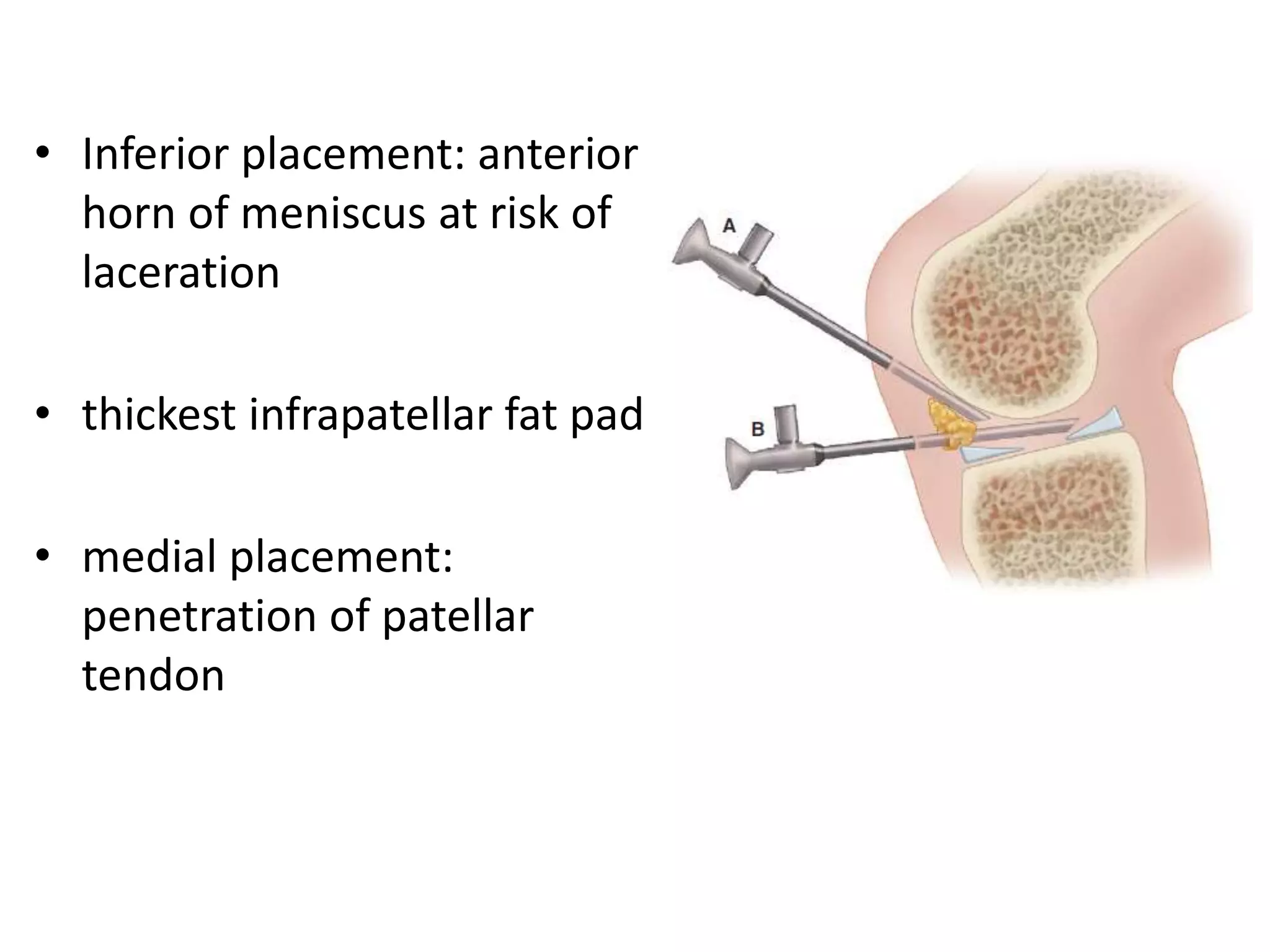 • Inferior placement: anterior
horn of meniscus at risk of
laceration
• thickest infrapatellar fat pad
• medial placement:
penetration of patellar
tendon
 