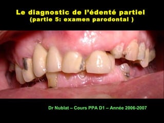 Le diagnostic de l’édenté partiel
(partie 5: examen parodontal )
Dr Nublat – Cours PPA D1 – Année 2006-2007
 