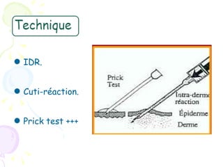 ● IDR.

● Cuti-réaction.

● Prick test +++
 
