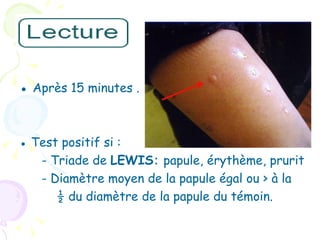 ● Après 15 minutes .


● Test positif si :
   - Triade de LEWIS: papule, érythème, prurit
   - Diamètre moyen de la papule égal ou > à la
      ½ du diamètre de la papule du témoin.
 