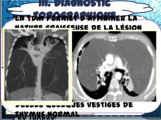 III. Diagnostic
           topographique
- 3.1.1-1-TDM permet d'affirmer la
   La les tumeurs thymiques
 a) Dystrophies thymiques bénignes
  nature graisseuse de la lésion
   Les thymolipomes (= tumeurs bénignes
  (valeurs négatives).
   rares)

 -Ils peuvent atteindre des volumes
- IRM, le thymolipomes présente
 très importants contrastant avec
  un signal intense de compression.
 l'absence de signes similaire au
  signal de la graisse sous-cutanée.
  -L'aspect est celui d'une tumeur
- graisseuse bénigne
   l'examen histopathologique
  décèle quelques vestiges de
 -thymus normal
   Rx thorax:
 