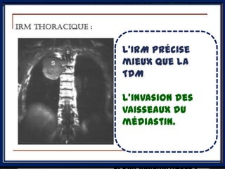 III. Diagnostic l’examen
                     TDM reste
                         limités
                     de parfois
                        choix.
        topographique
3.1.1-1- les tumeurs thymiques
                         polycyclique
                    Il précise:
b) Tumeurs malignes:1.Thymomes

b.1.1.Thymomes - caractère solide,
                    souvent
lymphoépithéliaux , polylobée
               unique, précise
                     lateralisée,
                  L’IRM
               masse dans la loge
                     calcifications++
 RX THORAX                  mieux que la
                           thymique,
                               +
                             TDM
                           - Rehaussement
                           aprèsEpanchement
                                injection du
                              l’invasion des
                                 pleural
                           produit de contraste
 TDM THORAX                  vaisseaux du
                           - caractère
                              médiastin.
                                Atéléctasie
                           encapsulé ou invasif (
                                segmentaire ou
                           envahissement des
                                lobaire dans
                           organes locorégionaux
                                les formes à
                           et métastases
 IRM THORAX                    évolution
 