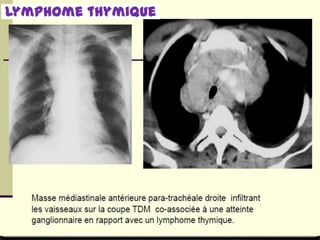 Lymphome thymique
 