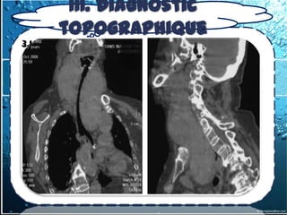III. Diagnostic
         topographique
3.1.1-2- les goitres endothoraciques
   Examen complémentaire
 Le scanner cervico-médiastinal :
 = l'examen de choix, qui permet
d'établir la nature thyroïdienne de la
tumeur sur deux arguments ( continuité avec le corps
thyroïde, même densité que les gros vaisseaux).

   TDM permet d'analyser le type
    anatomique exact et de prévoir ainsi
    le geste chirurgical
 