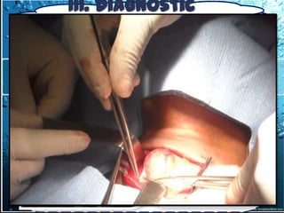 III. Diagnostic
         topographique
 3. 1-Tumeurs du médiastin antérieur
 3.1.1. Tumeur du médiastin antérieur supérieur
3.1.1-2- les goitres endothoraciques
  Examen complémentaire
 La Chirurgie ( cervicotomie)+++                 (source:
   CTCV CHNU Fann)
 