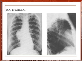 III. germinales bénignes
b) Les tumeurs
               Diagnostic
         topographique
b.3.Tératomes

 La majorité des teratomes est
  située dans le médiastin ant

   taille variable, plus au moins
    arrondies, présence parfois de
    calcification

   50 à 70 % des Tm germinales
    médiastinales.

   Asymptomatique : 2/3 cas, souvent
 