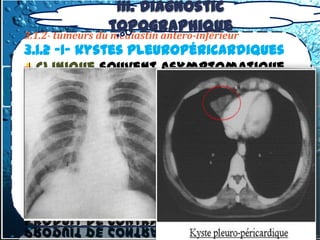 III. Diagnostic
                 topographique
3.1.2- tumeurs du médiastin antero-inférieur
3.1.2 -1- kystes pleuropéricardiques
  Clinique souvent asymptomatique.

  Rx thoracique:

  Echo thoracique:

 TDM.:
kyste , contenu liquidien sans
rehaussement apres injection du
produit de contraste.
 