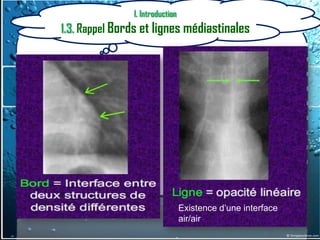 I. Introduction
1.3. Rappel Bords et lignes médiastinales




                                 Existence d’une interface
                                 air/air
 