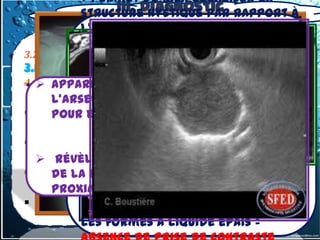 Permet de bien localiser la
                  III. Diagnostic
            structure kystique par rapport à
                 topographique
            l'axe trachéobronchique.( le
            diagnostic de kyste
3.2- tumeurs du- masse Moyen
                médiastin , opacité dense et
            bronchogénique)
3.2 -1.kystes bronchogéniques
            apporte des informations
                 homogène de forme
   Paraclinique
   apparue plus récemment dans bien
              similaires sur le plan
            Structure à contour très
                 légèrement oblongue
       l'arsenal des examens disponibles
              morphologique
            régulier, souple sans paroi
                 limitée.
 Rx thorax
       pouridentifiable.
             étudier le médiastin moyen
            Caractère trèsmasse du
            densité trèsla intense varie de
               - (profil): homogène,
 TDM 20 HU à 60-100 HU ou si le le
              signal des kystes carénaire,
                 parahilaire lorsque
   révèle bien le caractère kystique
              matériel de refoulement
                 signes endokystique est
            matériel endokystique est très
 IRM la lésion, lorsqu'elle se trouve à
       de épais. épais. vers le haut
              très
                 bronches
       proximité du tractus aérodigestif
 Echoendoeosophagienne
            Elément très important dans
            les formes à liquide épais =
 