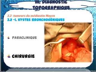 III. Diagnostic
                topographique
3.2- tumeurs du médiastin Moyen
3.2 -1. kystes bronchogéniques



   Paraclinique




   Chirurgie
 
