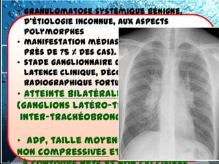 • Granulomatose systémique bénigne,
3.2- tumeurs du médiastin Moyen
  d'étiologie inconnue, aux aspects
3.2 -2.2. Adénopathies Bénignes :La
  polymorphes
sarcoidose
• manifestation médiastino-pulmonaires(
  près de 75 % des cas).
• stade ganglionnaire caractérisé par sa
  latence clinique, découverte
  RADIOGRAPHIQUE fortuite.
• Atteinte bilatérale et symétrique
(ganglions latéro-trachéaux &
 inter-trachéobronchiques.)

• ADP, taille moyenne,
non compressives et non confluentes
 