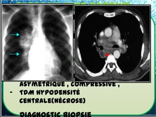 tuberculeuse tardive
- surtout chez le sujet VIH, ou
  débilité
- pas de problème diagnostique
- ADP hilaire associée aux ADP superficielle
  le plus souvent(CDD)+signes
  d’imprégnation chronique
- Unilatéral+++ bilatéral
  asymétrique , compressive ,
- TDM hypodensité
  centrale(nécrose)
 