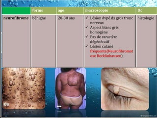 forme     age         macroscopie                   Dc
neurofibrome bénigne   20-30 ans    Lésion dvpé ds gros tronc   histologie
                                     nerveux
                                    Aspect blanc gris
                                     homogène
                                    Pas de caractère
                                     dégénératif
                                    Lésion cutané
                                     fréquente(Neurofibromat
                                     ose Recklinhausen)
 