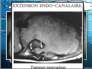 III. Diagnostic
          topographique
  3.3-tumeurs du médiastin Postérieur
  3.3-1- Tumeurs nerveuses

Manifestations
Radiographiques :
 Rx thorax:

 TDM Thoracique

 IRM
 