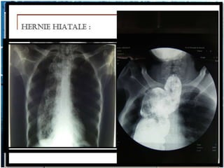 Diagnostic différentiel                      Examen
A - OPACITE    paroi : sternum, colonne (abcès             TDM+++
EXTRA-          Pottique)
MEDIASTINA     poumon : lésion parenchymateuse de
LE              siège juxta-médiastinal

               plèvre : épanchement pleural enkysté
                juxta-médiastinal

               diaphragme : les très rares tumeurs du
                diaphragme

B - ASPECT     Mégaœsophage, diverticule œsophagien        Lavement barytés du
PSEUDO-                                                      tube digestif
TUMORAL        Hernie hiatale fréquente rétro-cardiaque
D’ORIGINE       avec niveau liquide                         TDM( diagnostic de
DIGESTIVE                                                    hernie de la fente de
               Hernie diaphragmatique surtout hernie        Larrey )
                de la fente du Larrey
                                                            Echo ou le scanner
               Plus rarement, tumeur de la convexité        (tumeur hépatique).
                du foie.
 