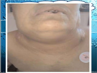 II. Diagnostic positif
          II.1. CDD: 1. Syndromes médiastinaux


b)compression veineuse
  Syndrome cave supérieur
   compression du canal thoracique
- céphalées, vertiges, bourdonnements d’oreille,
troubles visuels, obnubilation
   atteinte nerveuse
- cyanose de la face accentuée par la toux et les efforts
   compression de l’œsophage
-Œdème (très caractéristiques)
   tamponnade cardiaque
   Douleurs médiastinales
- TVJ majorée { la toux (manœuvre de vasalva)

-CVC pré thoracique, signe de La bêche de Sorlano (à
rechercher)
 