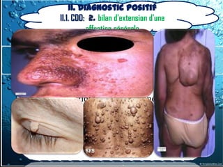 II. Diagnostic positif
        II.1. CDD: 2. bilan d'extension d'une
                  affection générale


- La constatation d'un syndrome de Pierre-
  Marie a le mérite d'évoquer immédiatement
  une affection intrathoracique

- La constatation de signes cutanés d'une
  maladie de Recklinghausen peut faire
  découvrir une tumeur latente du médiastin
  postérieur.
 