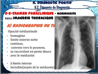 II. Diagnostic positif
                    II.2. Éléments du Diagnostic
2-2-Examen Paraclinique – Noninvasifs
2.2.1.1. Imagerie thoracique

a) radiographie du thorax
 Opacité médiastinale
- homogène
- limite externe nette
- continue,
- convexe vers le poumon,
- se raccordant en pente douce
- avec le médiastin

- à limite interne
- Invisible(noyée ds le médiastin)
 