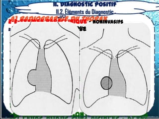 II. Diagnostic positif
                II.2. Éléments du Diagnostic
 a) radiographie du thorax
2-2-Examen Paraclinique – Noninvasifs
  SIGNE DE LA SILHOUETTE DE FELSON
2.2.1.1. Imagerie thoracique


De    grande     valeur    pour    la
détermination     topographique    au
niveau des interfaces cardiaques et
aortiques
« lorsque 2 opacités de même densité
au contact l’une de l’autre :
-Si leurs bords s’effacent : même
plan
-Si leurs bords sont visibles : plans
 
