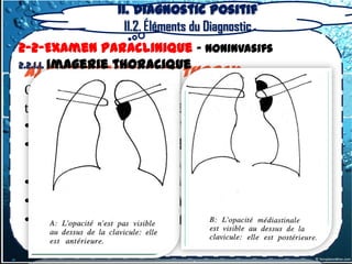 II. Diagnostic positif
                 II.2. Éléments du Diagnostic
2-2-Examen Paraclinique – Noninvasifs
2.2.1.1. Imagerie thoracique
a) radiographie du thorax
Quelques signes classiques de repérage
topographique méritent d’être rappelés :
• Le signe cervico-thoracique
• Le signe de l’iceberg ou signe
  thoraco-abdominal
• Le signe de la convergence du hile
• Le signe de recouvrement du hile
• Le signe de l’attraction de
  l’œsophage
 