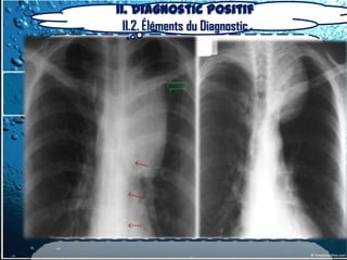 II. Diagnostic positif
  II.2. Éléments du Diagnostic
 