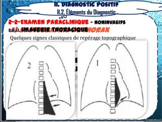 II. Diagnostic positif
                    II.2. Éléments du Diagnostic
2-2-Examen Paraclinique – Noninvasifs
 a) radiographie du thorax
2.2.1.1. Imagerie thoracique
Quelques signes classiques de repérage topographique
méritent d’être rappelés :
• Le signe cervico-thoracique
• Le signe de l’iceberg ou signe
  thoraco-abdominal
• Le signe de la convergence du hile
• Le signe de recouvrement du hile
• Le signe de l’attraction de
  l’œsophage
 