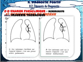 II. Diagnostic positif
                    II.2. Éléments du Diagnostic
2-2-Examen Paraclinique – Noninvasifs
 a) radiographie du thorax
2.2.1.1. Imagerie thoracique
Quelques signes classiques de repérage topographique
méritent d’être rappelés :


• Le signe cervico-thoracique
• Le signe de l’iceberg ou signe
  thoraco-abdominal
• Le signe de la convergence du hile
• Le signe de recouvrement du hile
• Le signe de l’attraction de
  l’œsophage
 
