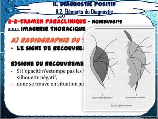 II. Diagnostic positif
                    II.2. Éléments du Diagnostic
2-2-Examen Paraclinique – Noninvasifs
2.2.1.1. Imagerie thoracique

a) radiographie du thorax
• Le signe de recouvrement du hile

b)Signe du recouvrement postérieur
- Si l'opacité n'estompe pas les bords du cœur, signe de la
  silhouette négatif,
- donc se trouve en situation postérieure
 