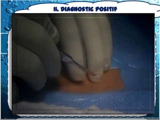 II. Diagnostic positif
               II.2. Éléments du Diagnostic
       2-2-Examen Paraclinique
2-2-2-Examens invasifs
2.2.2.3. a) médiastinoscopie

 Par voie cervicale sus sternale
 Incision est cervicale (vidéo)

 La médiastinoscopie permet :
-le diagnostic des tumeur thymiques
-les prélèvements des ganglions péri-
trachéaux, inter-trachéo-bronchiques.
 