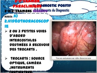 2-2-Examen
            II. Diagnostic positif
    Paraclinique
2-2-2-Examens invasifs du Diagnostic
               II.2. Éléments
2.2.2.3. a)

2.Vidéothoracoscop
ie
 2 ou 3 petites voies
  d'abord
  intercostales
  destinées à recevoir
  des trocarts .

 trocarts : source
  optique, caméra
  ,instruments
 
