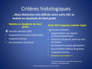 Critères histologiques
Nodule en dysplasie de haut
grade
• Densité cellulaire (2N)
• Irrégularité structure trabéculaire
• Unpaired arteries
• Accumulation de graisse
Early-HCC (vaguely nodular type)
• Densité cellulaire
• Augmentation du rapport
nucléocytoplasmique
• Présence d’espaces porte au sein
du nodule
• Architecture pseudo-glandulaire
• Accumulation diffuse de graisse
• Unpaired arteries
• Invasion stromale ++
International Consensus Group for Hepatocellular
Neoplasia, Hepatology 2009
journées DES Besançon 15-16 mars 2013
…Mais distinction très difficile entre early HCC et
nodule en dysplasie de haut grade
 
