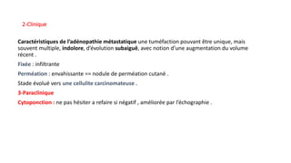 Caractéristiques de l’adénopathie métastatique une tuméfaction pouvant être unique, mais
souvent multiple, indolore, d’évolution subaiguë, avec notion d’une augmentation du volume
récent .
Fixée : infiltrante
Perméation : envahissante == nodule de perméation cutané .
Stade évolué vers une cellulite carcinomateuse .
3-Paraclinique
Cytoponction : ne pas hésiter a refaire si négatif , améliorée par l’échographie .
2-Clinique
 