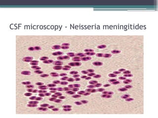 CSF microscopy - Neisseria meningitides
 