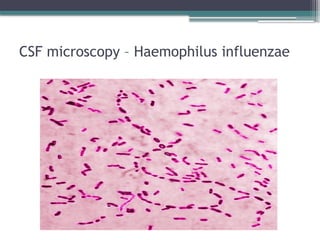 CSF microscopy – Haemophilus influenzae
 