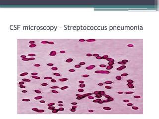 CSF microscopy – Streptococcus pneumonia
 