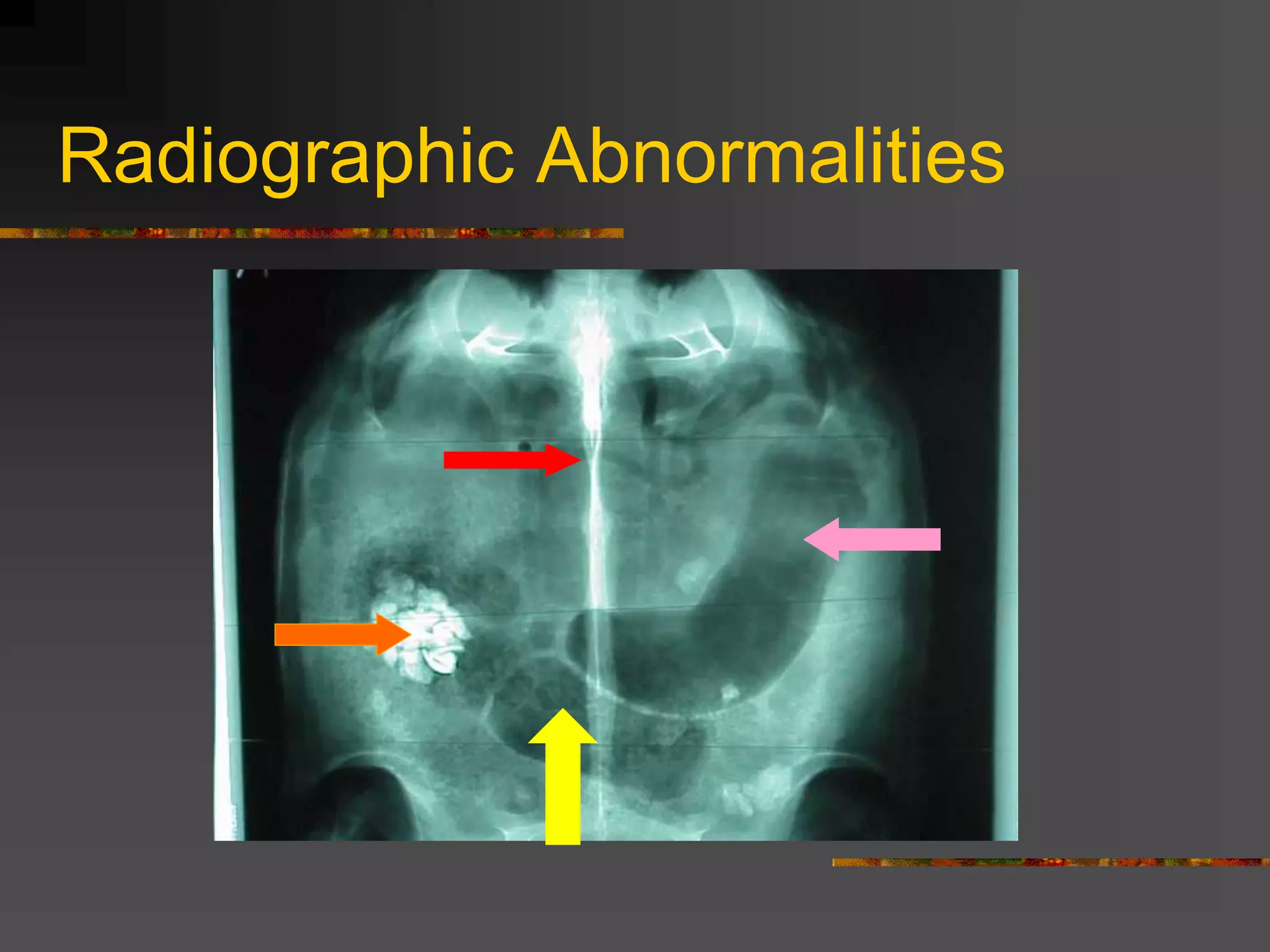 Radiographic Abnormalities
 