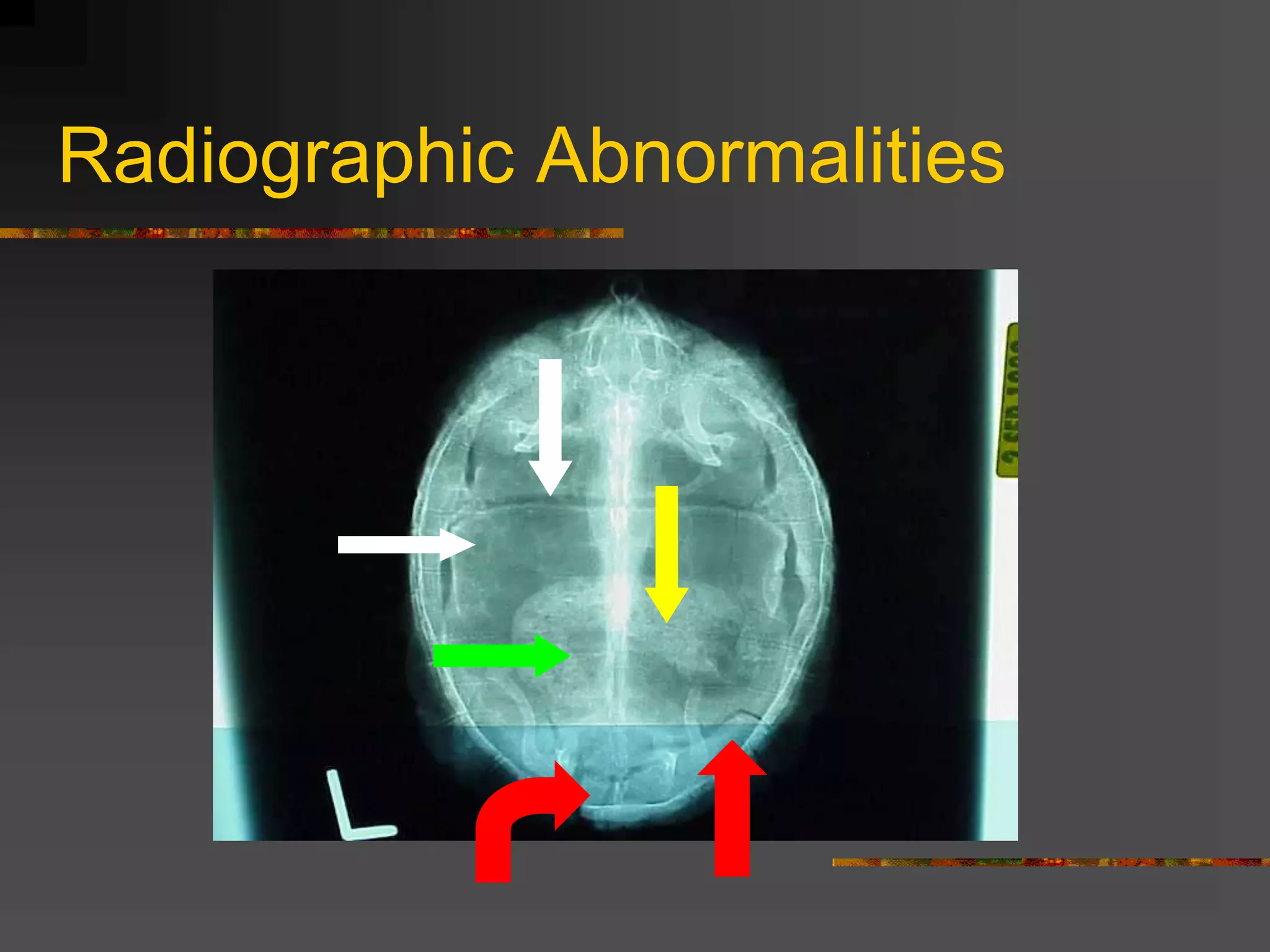 Radiographic Abnormalities
 