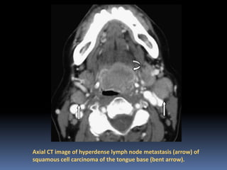 Axial CT image of hyperdense lymph node metastasis (arrow) of
squamous cell carcinoma of the tongue base (bent arrow).

 