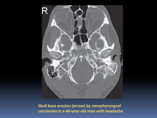 Skull base erosion (arrow) by nasopharyngeal
carcinoma in a 40-year-old man with headache

 