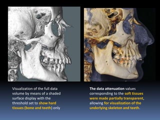 Visualization of the full data
volume by means of a shaded
surface display with the
threshold set to show hard
tissues (bone and teeth) only

The data attenuation values
corresponding to the soft tissues
were made partially transparent,
allowing for visualization of the
underlying skeleton and teeth.

 