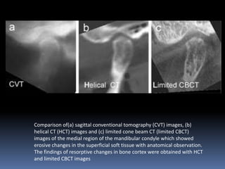 Comparison of(a) sagittal conventional tomography (CVT) images, (b)
helical CT (HCT) images and (c) limited cone beam CT (limited CBCT)
images of the medial region of the mandibular condyle which showed
erosive changes in the superficial soft tissue with anatomical observation.
The findings of resorptive changes in bone cortex were obtained with HCT
and limited CBCT images

 