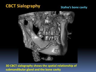 CBCT Sialography

Stafne’s bone cavity

3D CBCT sialography shows the spatial relationship of
submandibular gland and the bone cavity

 