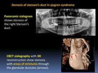 Stenosis of stensen’s duct in sjogren syndrome

Panoramic sialogram
shows stenosis of
the right Stensen’s
duct.

CBCT sialography with 3D
reconstruction show stenosis
with areas of strictures through
the glandular ductules (arrows).

 