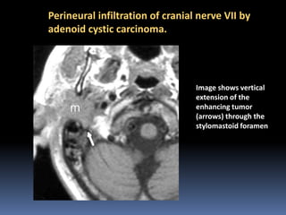 Perineural infiltration of cranial nerve VII by
adenoid cystic carcinoma.

Image shows vertical
extension of the
enhancing tumor
(arrows) through the
stylomastoid foramen

 