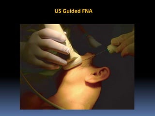 US Guided FNA

 