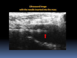 Ultrasound image
with the needle inserted into the mass

 